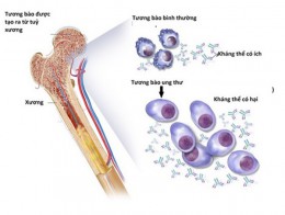 Phương thức điều trị bệnh đa u tủy xương mới dựa trên công nghệ RNA