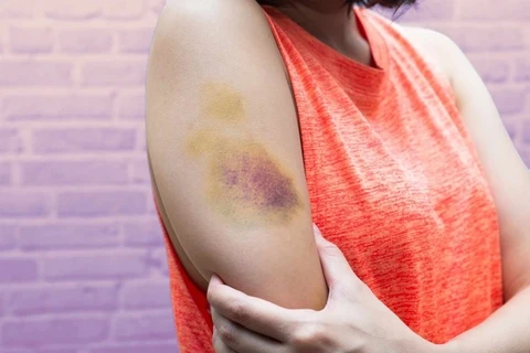 Những dấu hiệu trên da cảnh báo bệnh nguy hiểm