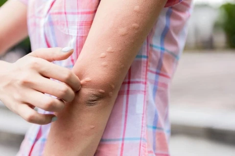 Dấu hiệu cảnh báo bạn đã mắc sốt xuất huyết