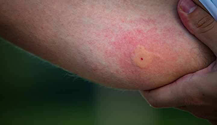 Bệnh nhân 19 tuổi nguy kịch vì căn bệnh tưởng chỉ trẻ em mắc
