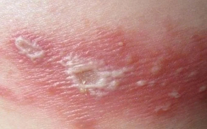 Zona gây đau đớn đến mức nào?