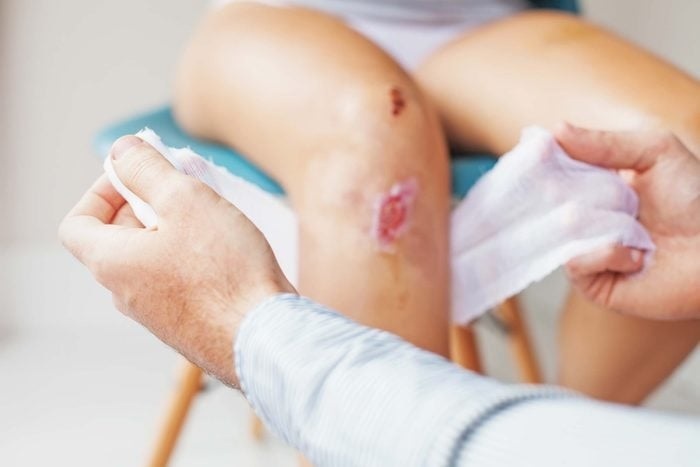 Dấu hiệu vết thương hở có thể bị nhiễm trùng