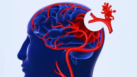 Nguyên nhân gây đột quỵ không triệu chứng, bác sĩ chỉ cách nhận biết