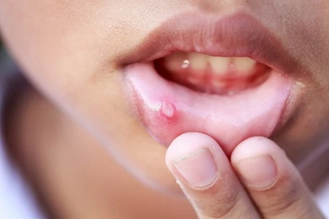 5 điều quan trọng cần biết về nhiệt miệng