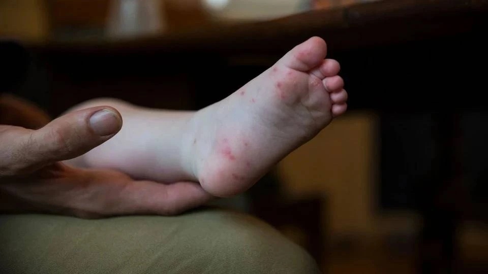 Vì sao trẻ mắc tay chân miệng nhiều lần?