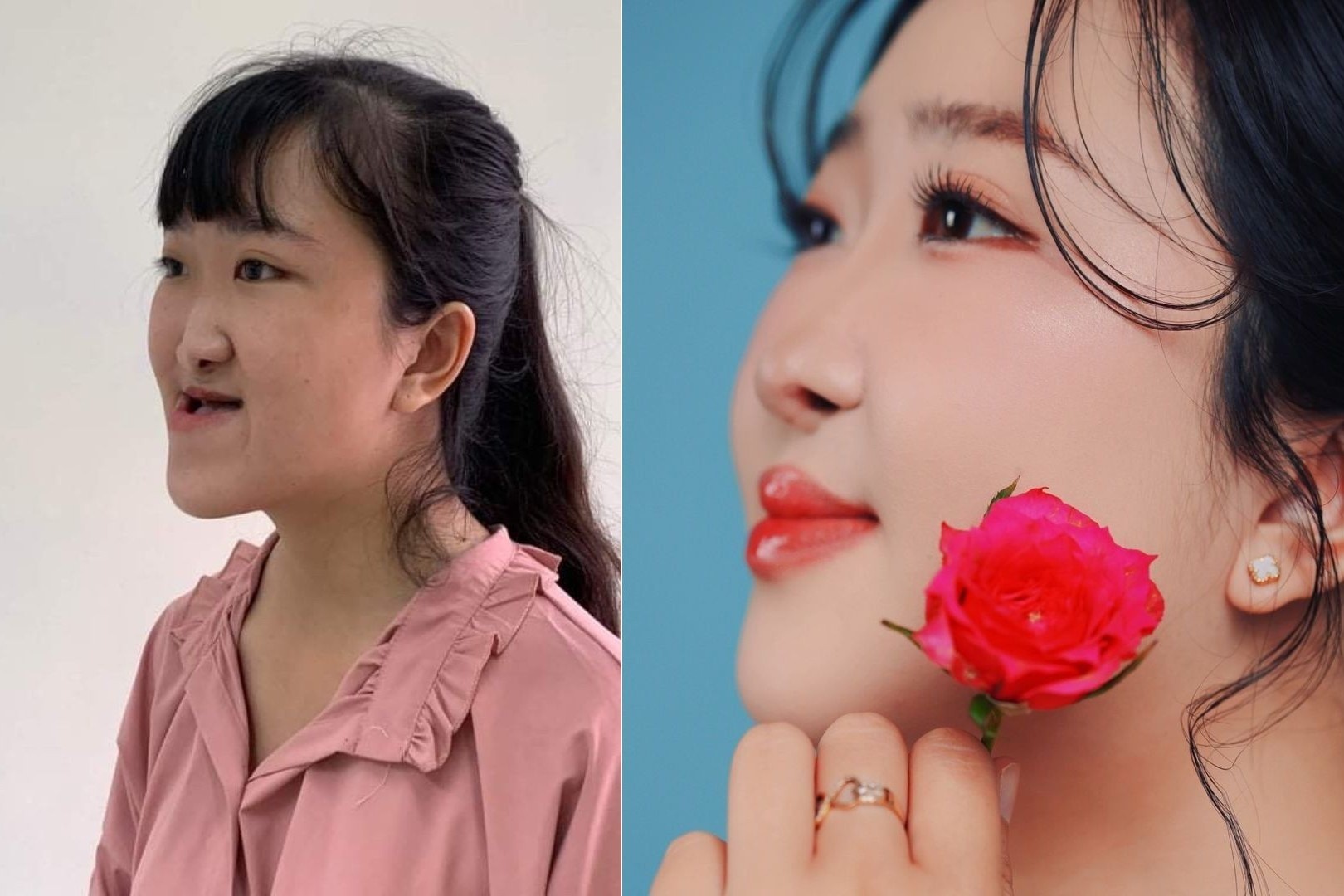 Cô gái 25 tuổi 'lột xác' sau 4 lần phẫu thuật hàm mặt